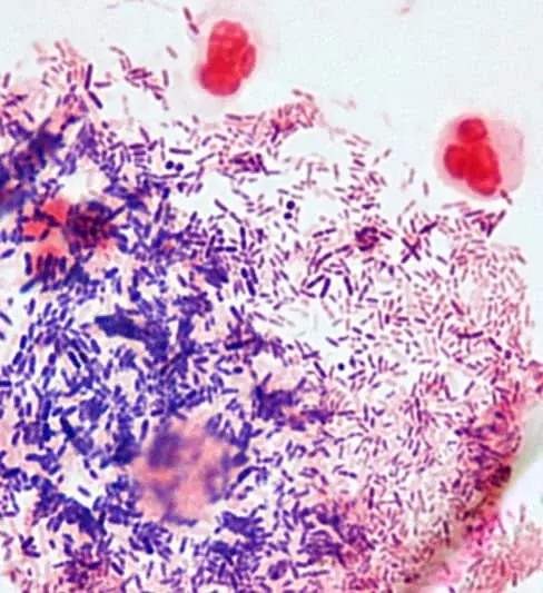 Clue cells Gardnerella vaginalis